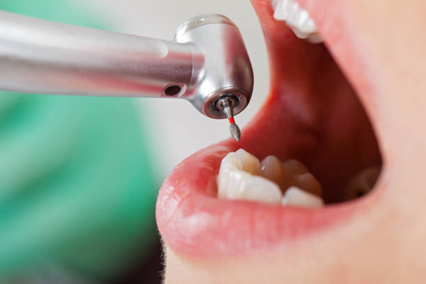 Best Emergency Wisdom Tooth Extraction in Carlisle, IA